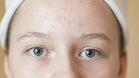 一般的なニキビ治療薬が「統合失調症リスク」を軽減する可能性🧠